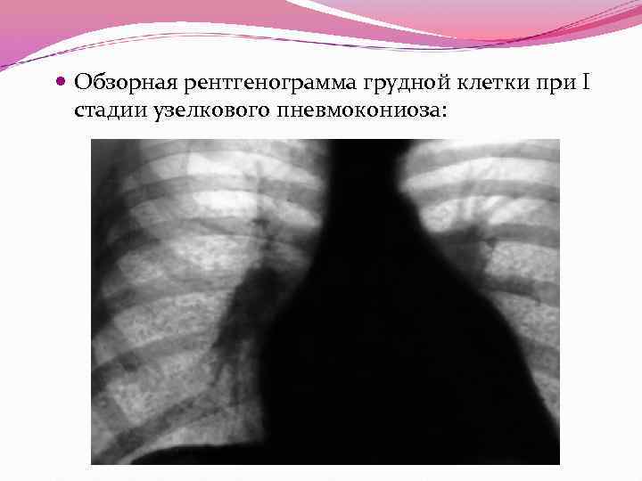  Обзорная рентгенограмма грудной клетки при I стадии узелкового пневмокониоза: 