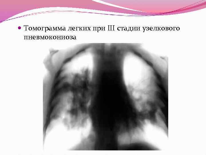 Томограмма легких при III стадии узелкового пневмокониоза 