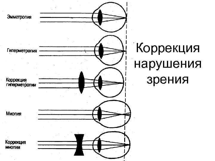 Эмметропическая рефракция. Схему рефракции при эмметропии, миопии, гиперметропии. Схему рефракции при эмметропии. Гиперметропия у детей клинические рекомендации. Эмметропия миопия гиперметропия.