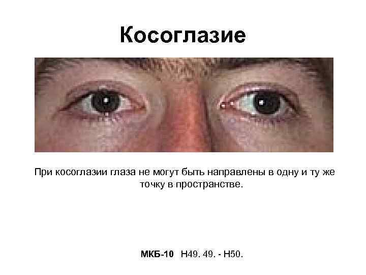 Косоглазие При косоглазии глаза не могут быть направлены в одну и ту же точку