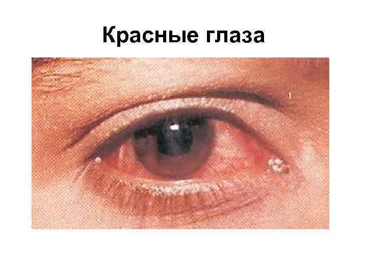 Красные глаза 