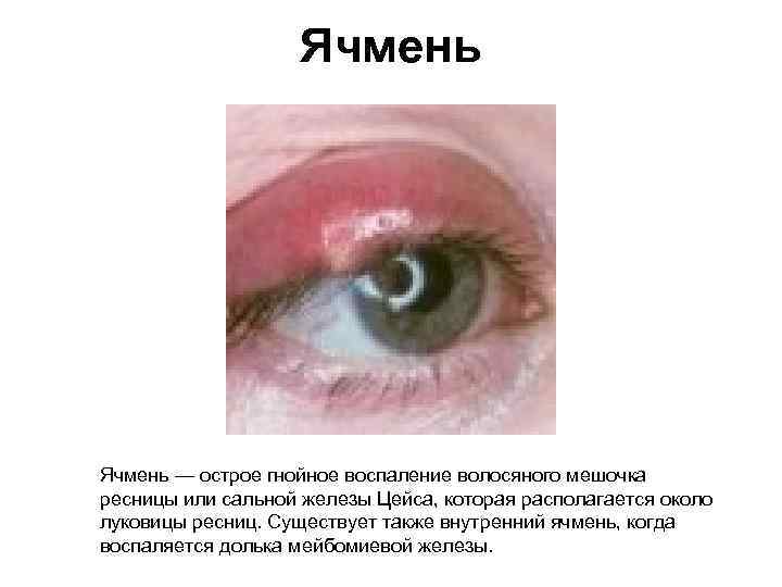 Ячмень — острое гнойное воспаление волосяного мешочка ресницы или сальной железы Цейса, которая располагается