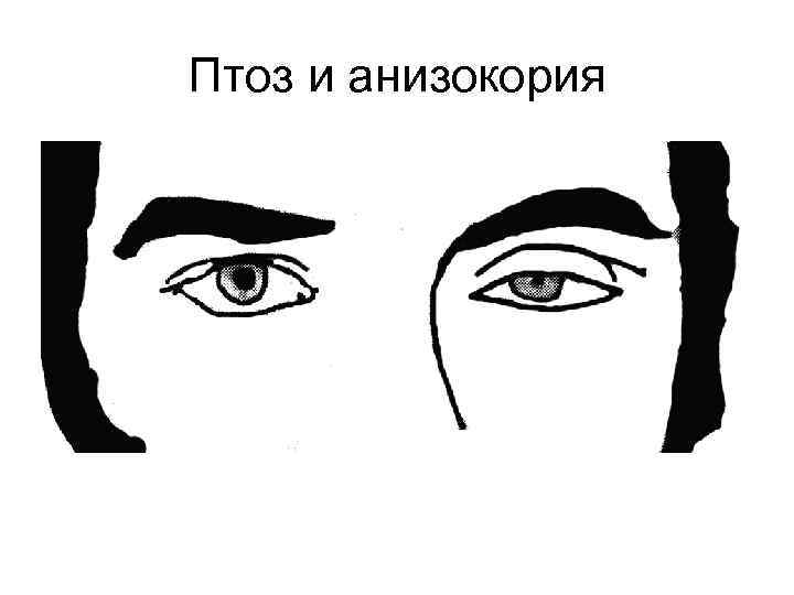 Птоз и анизокория 