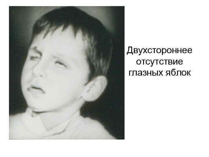 Двухстороннее отсутствие глазных яблок 