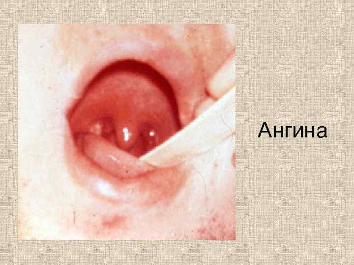 Ангина 