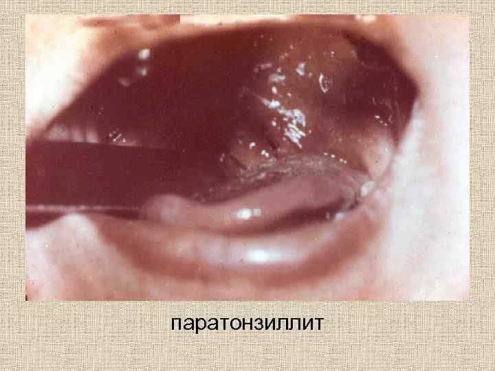 паратонзиллит 