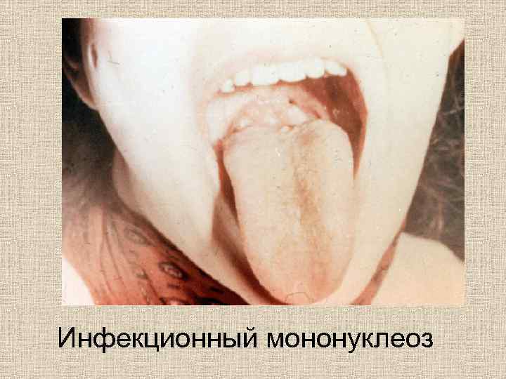 Инфекционный мононуклеоз 