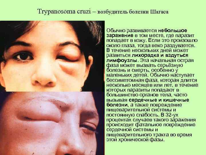 Trypanosoma cruzi – возбудитель болезни Шагаса • Обычно развивается небольшое заражение в том месте,