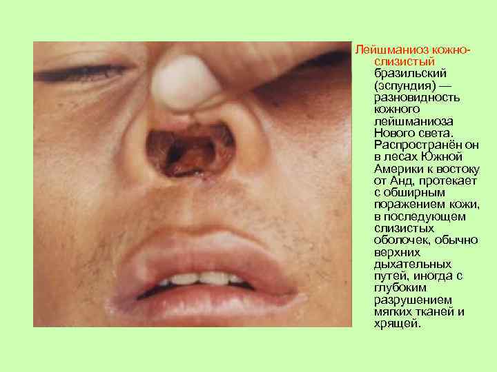 Лейшманиоз кожнослизистый бразильский (эспундия) — разновидность кожного лейшманиоза Нового света. Распространён он в лесах