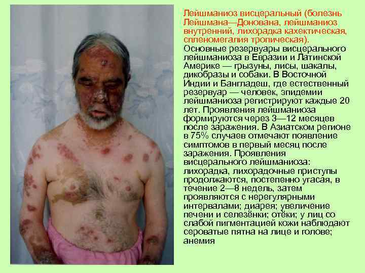 Лейшманиоз висцеральный (болезнь Лейшмана—Донована, лейшманиоз внутренний, лихорадка кахектическая, спленомегалия тропическая). Основные резервуары висцерального лейшманиоза