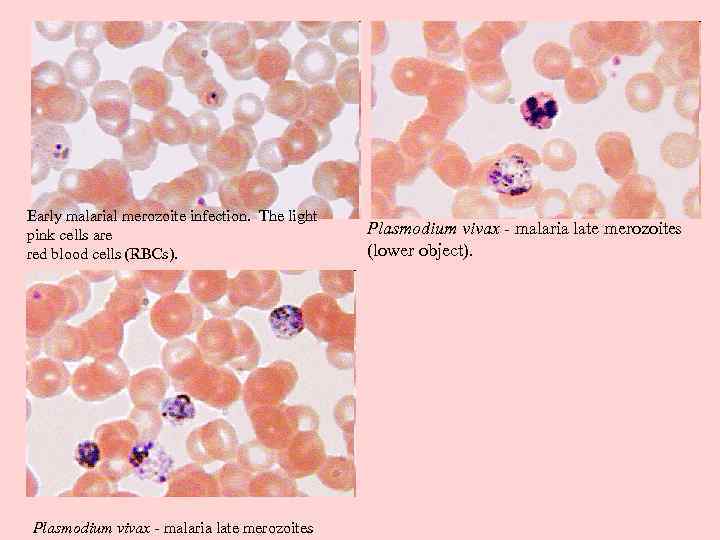 Early malarial merozoite infection. The light pink cells are red blood cells (RBCs). Plasmodium