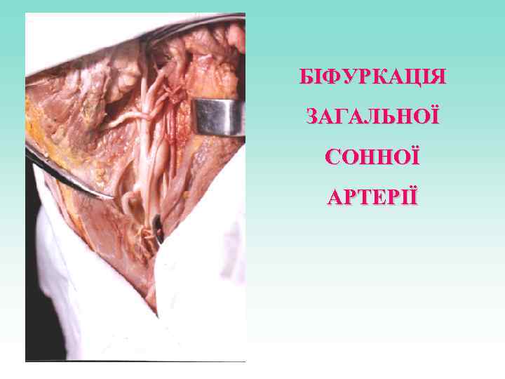 БІФУРКАЦІЯ ЗАГАЛЬНОЇ СОННОЇ АРТЕРІЇ 