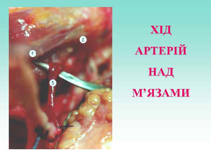 ХІД АРТЕРІЙ НАД М’ЯЗАМИ 