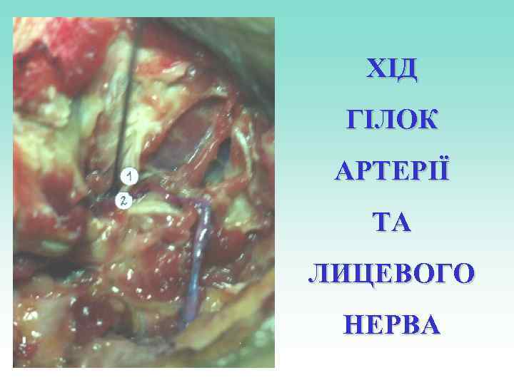 ХІД ГІЛОК АРТЕРІЇ ТА ЛИЦЕВОГО НЕРВА 