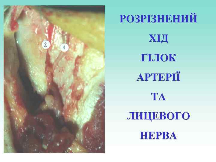 РОЗРІЗНЕНИЙ ХІД ГІЛОК АРТЕРІЇ ТА ЛИЦЕВОГО НЕРВА 