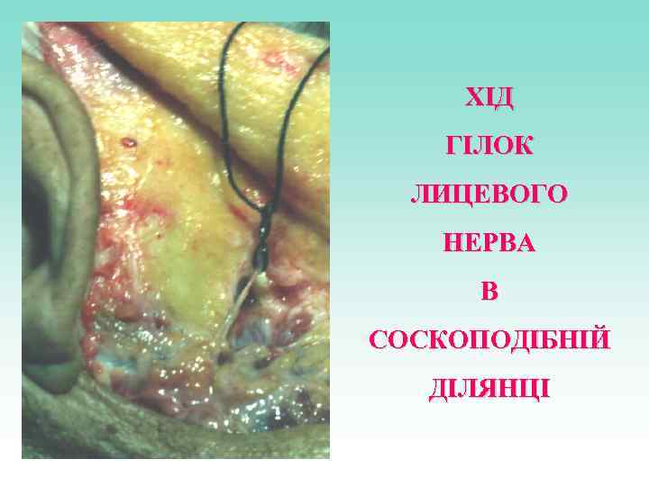 ХІД ГІЛОК ЛИЦЕВОГО НЕРВА В СОСКОПОДІБНІЙ ДІЛЯНЦІ 