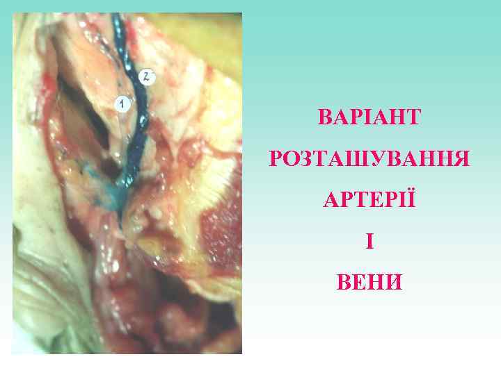 ВАРІАНТ РОЗТАШУВАННЯ АРТЕРІЇ І ВЕНИ 