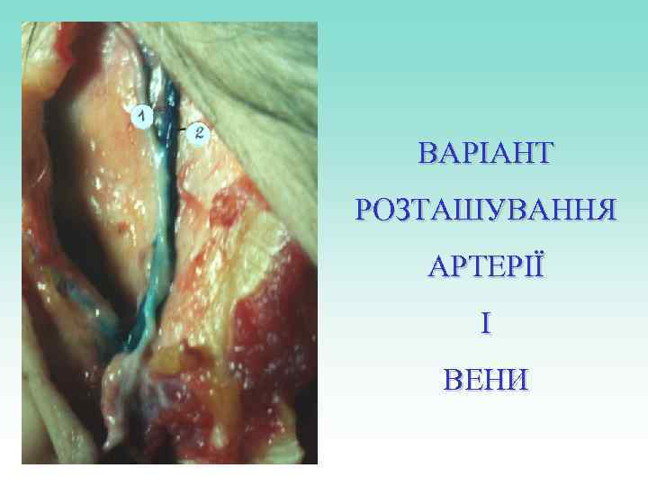 ВАРІАНТ РОЗТАШУВАННЯ АРТЕРІЇ І ВЕНИ 