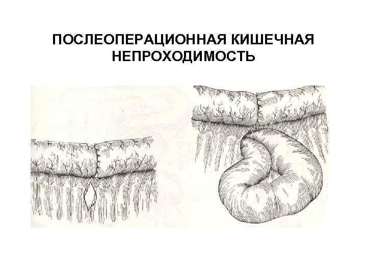 Кишечная непроходимость код 10