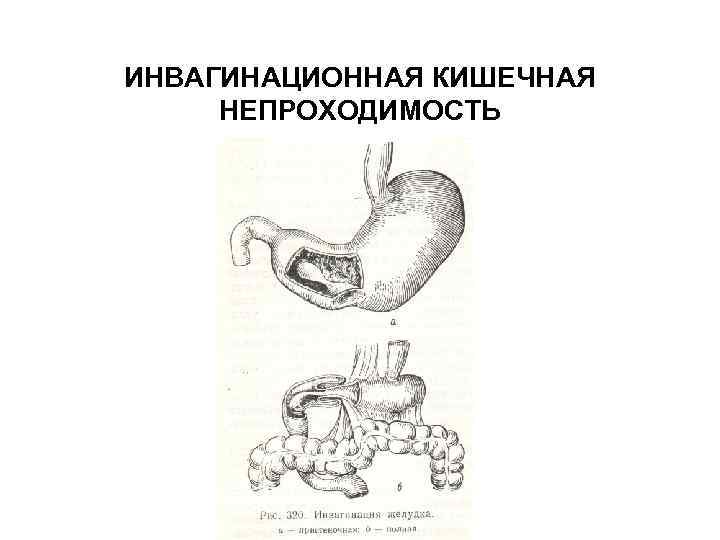 ИНВАГИНАЦИОННАЯ КИШЕЧНАЯ НЕПРОХОДИМОСТЬ 