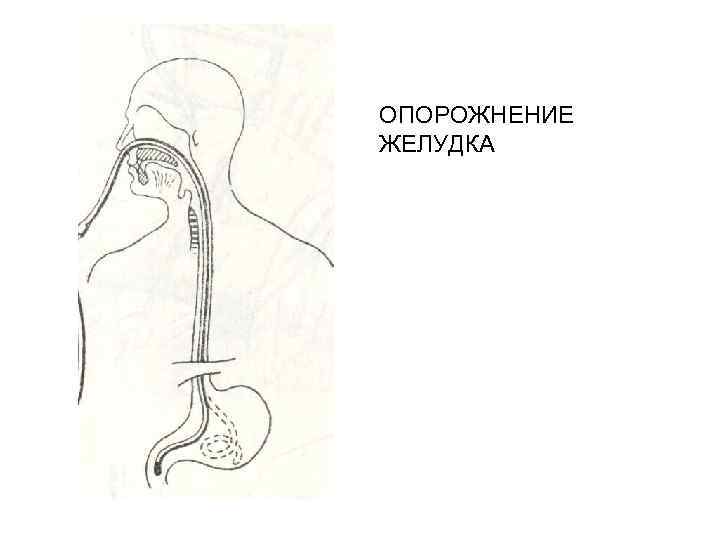 ОПОРОЖНЕНИЕ ЖЕЛУДКА 
