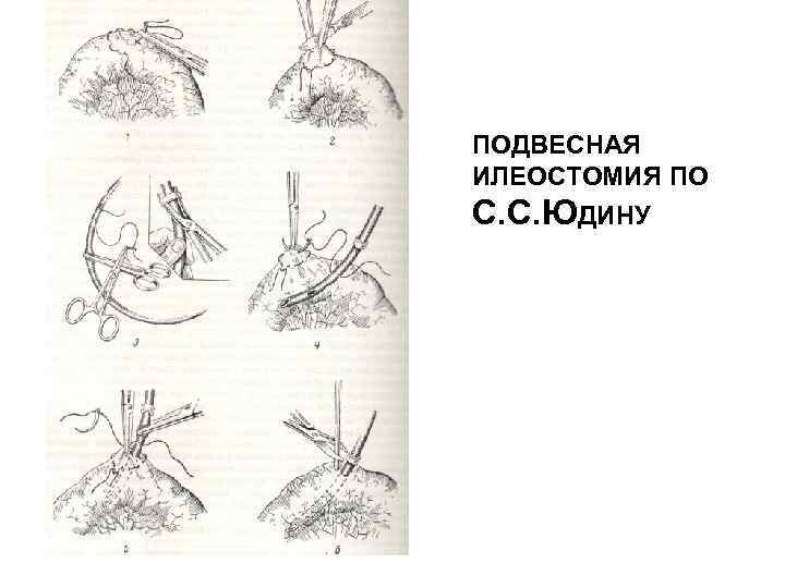 ПОДВЕСНАЯ ИЛЕОСТОМИЯ ПО С. С. ЮДИНУ 