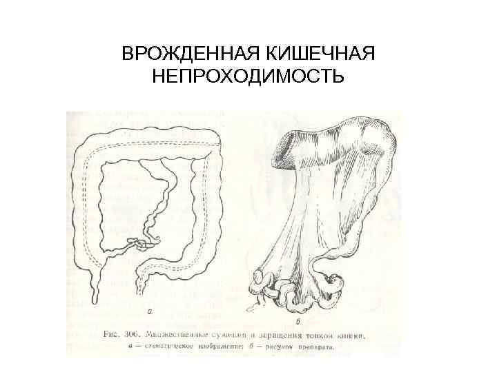 Врожденная кишечная