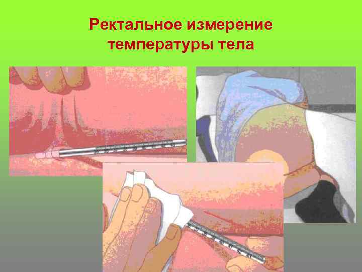 Ректальное измерение температуры тела 