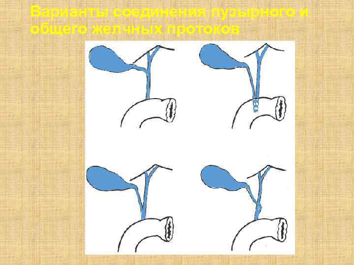 Варианты соединения пузырного и общего желчных протоков 
