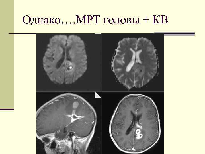 Однако…. МРТ головы + КВ 