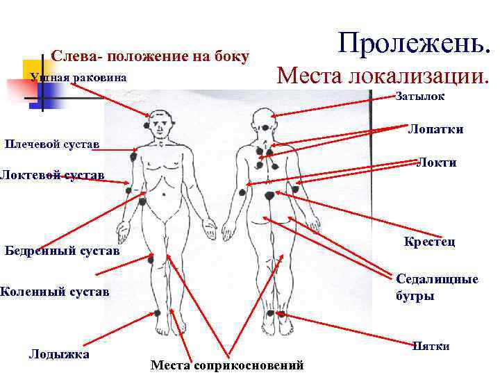 Схема места образования пролежней