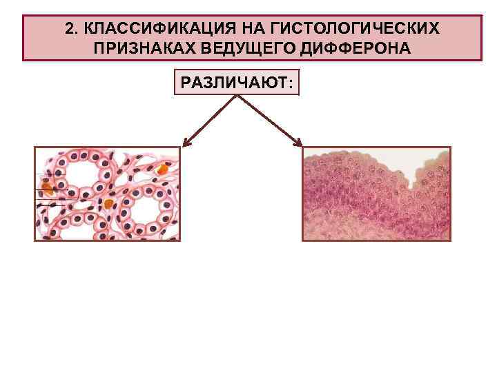 2. КЛАССИФИКАЦИЯ НА ГИСТОЛОГИЧЕСКИХ ПРИЗНАКАХ ВЕДУЩЕГО ДИФФЕРОНА РАЗЛИЧАЮТ: 