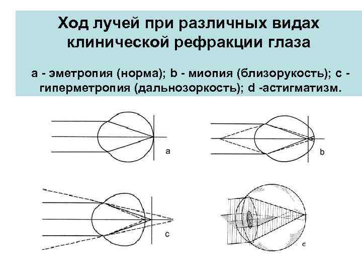 Ход лучей при различных видах клинической рефракции глаза a - эметропия (норма); b -