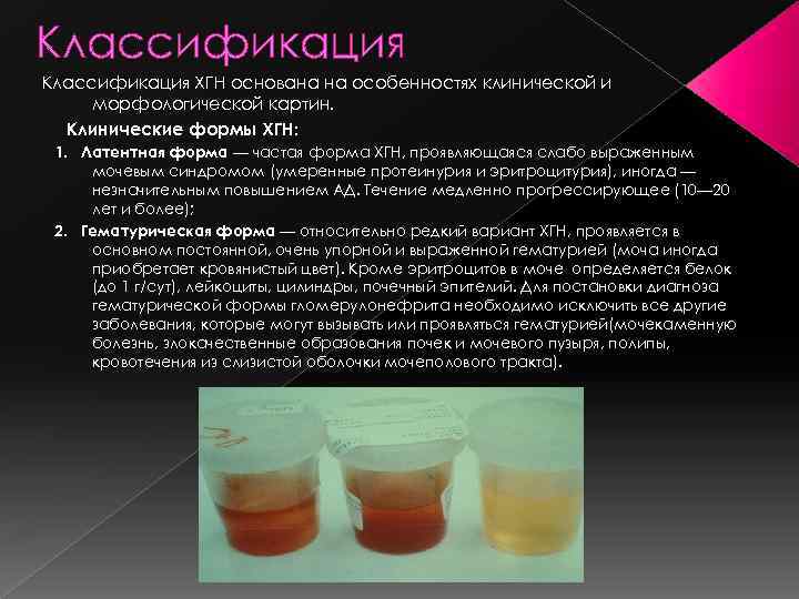 Классификация ХГН основана на особенностях клинической и морфологической картин. Клинические формы ХГН: 1. Латентная