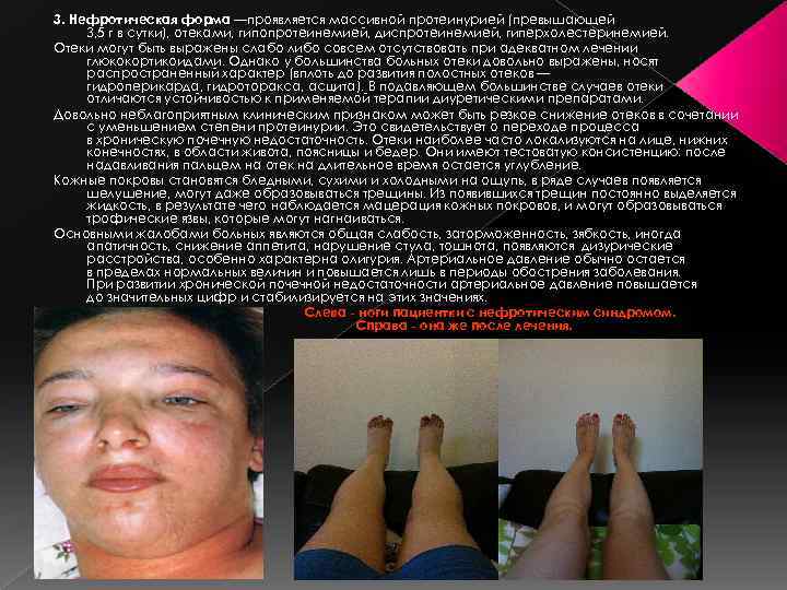 3. Нефротическая форма —проявляется массивной протеинурией (превышающей 3, 5 г в сутки), отеками, гипопротеинемией,