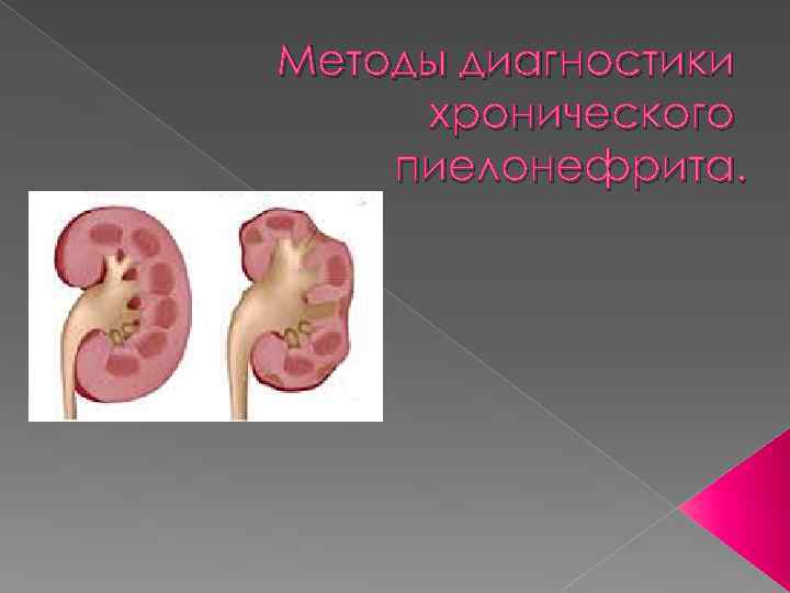 Методы диагностики хронического пиелонефрита. 