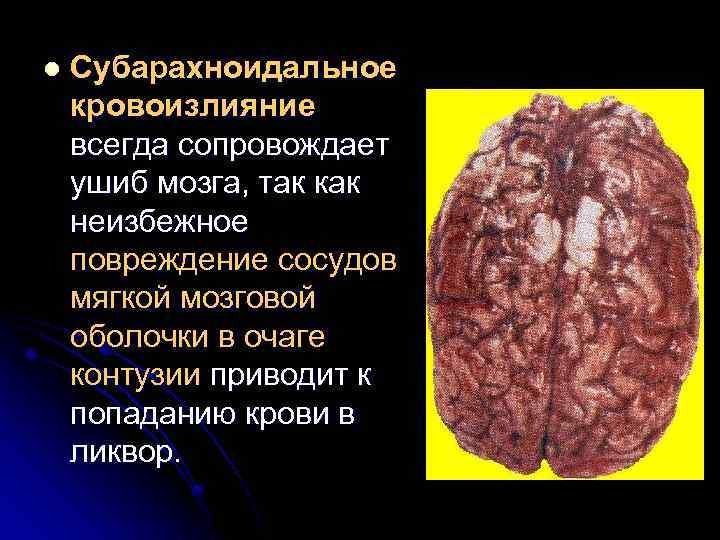 l Субарахноидальное кровоизлияние всегда сопровождает ушиб мозга, так как неизбежное повреждение сосудов мягкой мозговой