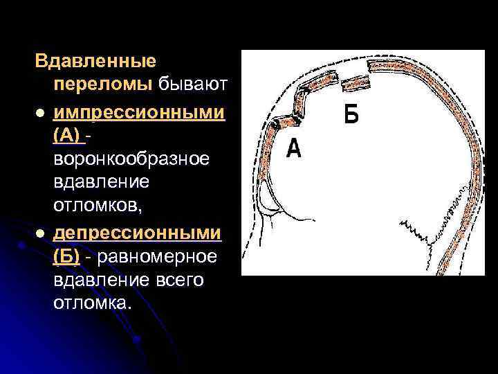 Вдавленные переломы бывают l импрессионными (А) воронкообразное вдавление отломков, l депрессионными (Б) - равномерное