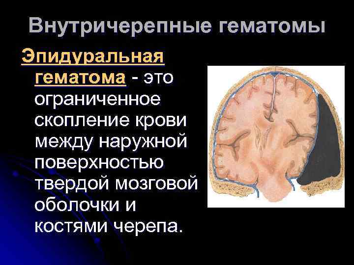 Внутричерепные гематомы Эпидуральная гематома - это ограниченное скопление крови между наружной поверхностью твердой мозговой