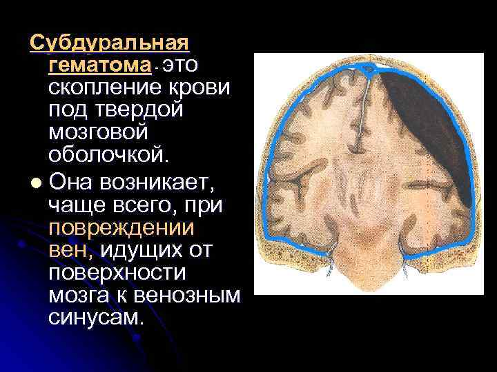 Субдуральная гематома - это скопление крови под твердой мозговой оболочкой. l Она возникает, чаще