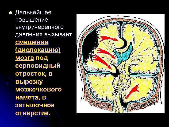 l Дальнейшее повышение внутричерепного давления вызывает смещение (дислокацию) мозга под серповидный отросток, в вырезку