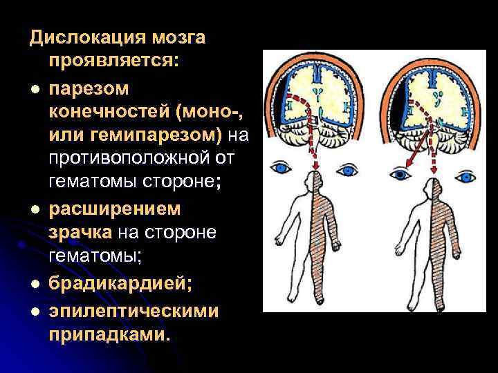 Дислокация мозга проявляется: l парезом конечностей (моно-, или гемипарезом) на противоположной от гематомы стороне;