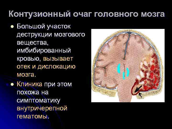 Контузионный очаг головного мозга l l Большой участок деструкции мозгового вещества, имбибированный кровью, вызывает