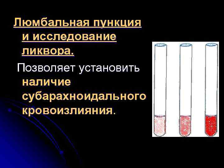 Люмбальная пункция и исследование ликвора. Позволяет установить наличие субарахноидального кровоизлияния. 