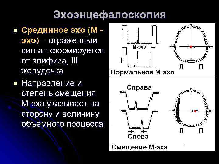 Эхоэнцефалоскопия l l Срединное эхо (М эхо) – отраженный сигнал формируется от эпифиза, III