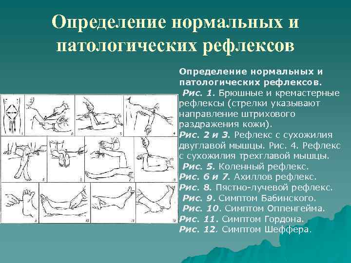Определение нормальных и патологических рефлексов. Рис. 1. Брюшные и кремастерные рефлексы (стрелки указывают направление