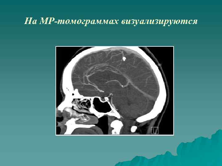 На МР-томограммах визуализируются 