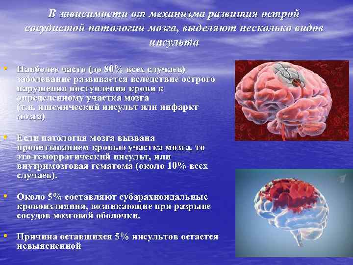 Нарушение мозгового кровообращения типы. Какие виды инсульта бывают. ОНМК картинки.