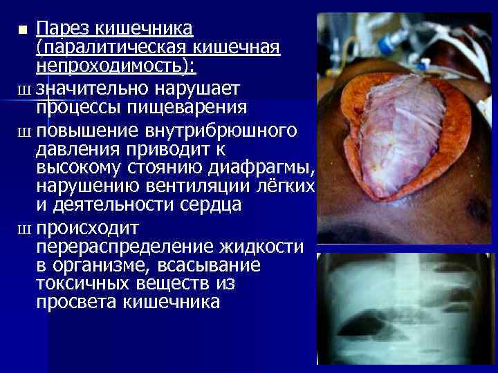 Парез кишечника (паралитическая кишечная непроходимость): Ш значительно нарушает процессы пищеварения Ш повышение внутрибрюшного давления