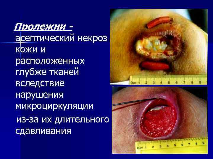 Пролежни - асептический некроз кожи и расположенных глубже тканей вследствие нарушения микроциркуляции из-за их